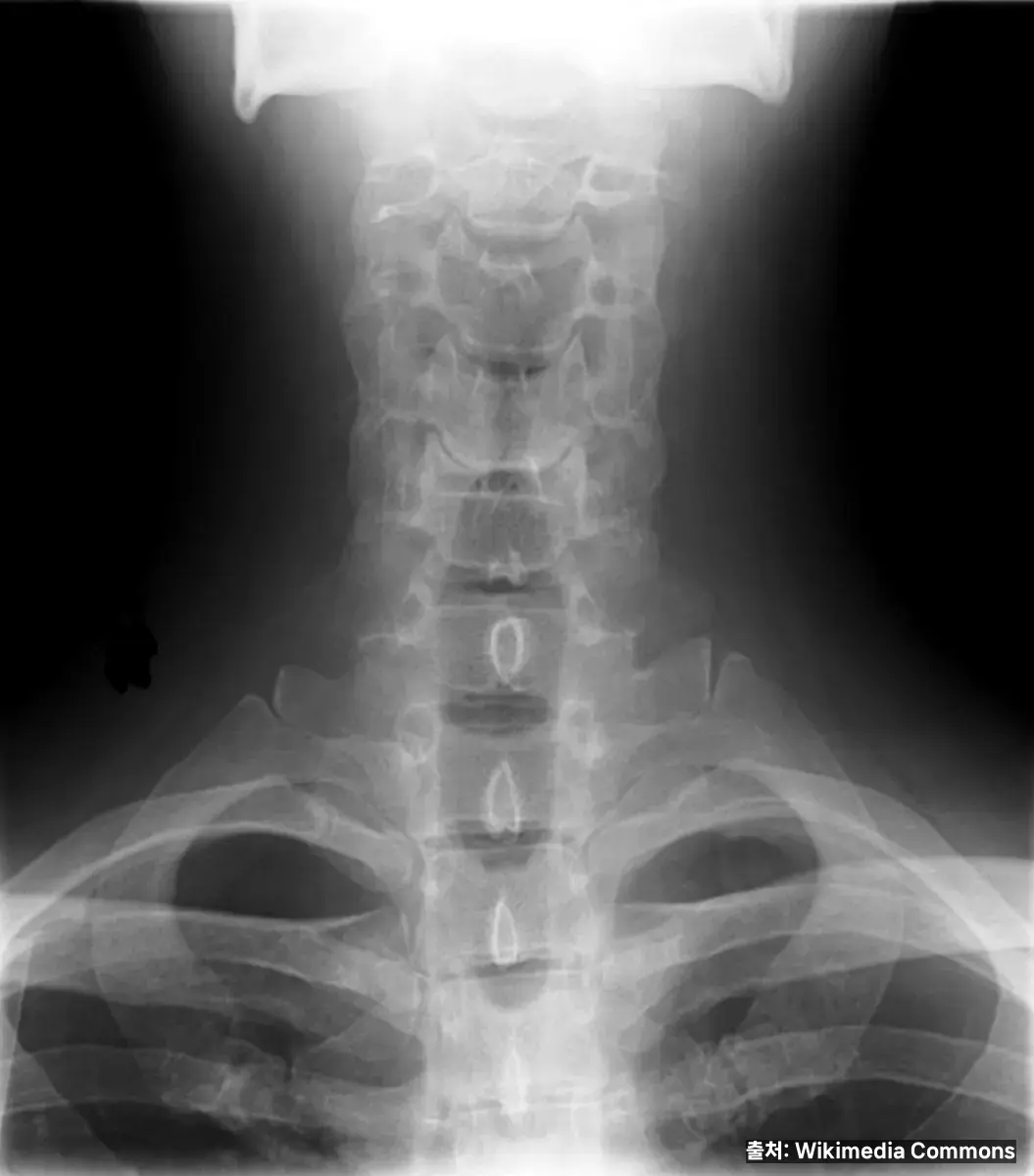 목 디스크 초기 증상 관련 이미지
