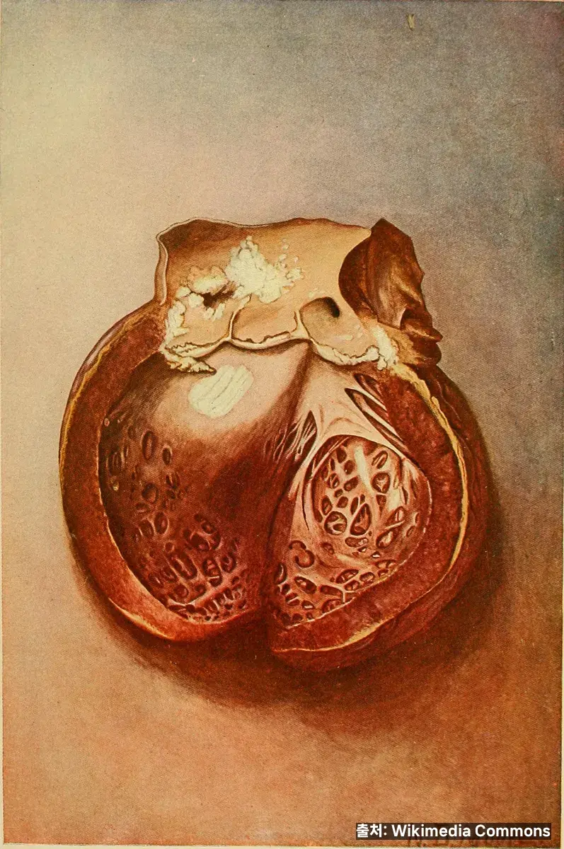 혈압 부종 관련 이미지