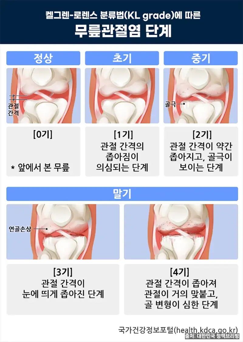 무릎 관절염 진단·치료 - 대한민국 정책브리핑